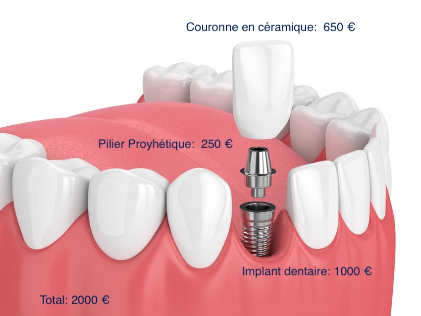 Quel est le prix d'un implant dentaire ?