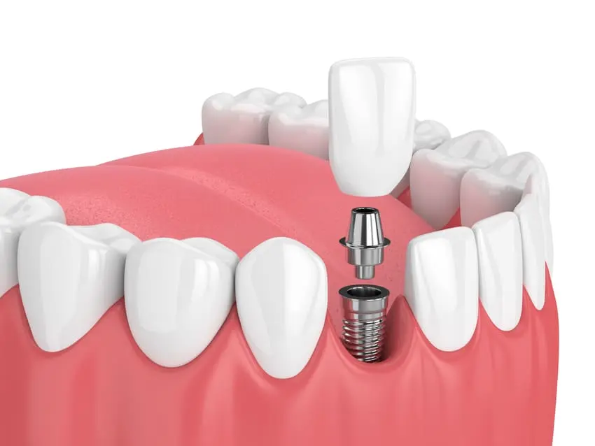 Implant dentaire prix