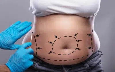 Quel est le prix dune abdominoplastie en Tunisie Quel est le prix d’une abdominoplastie en Tunisie ?