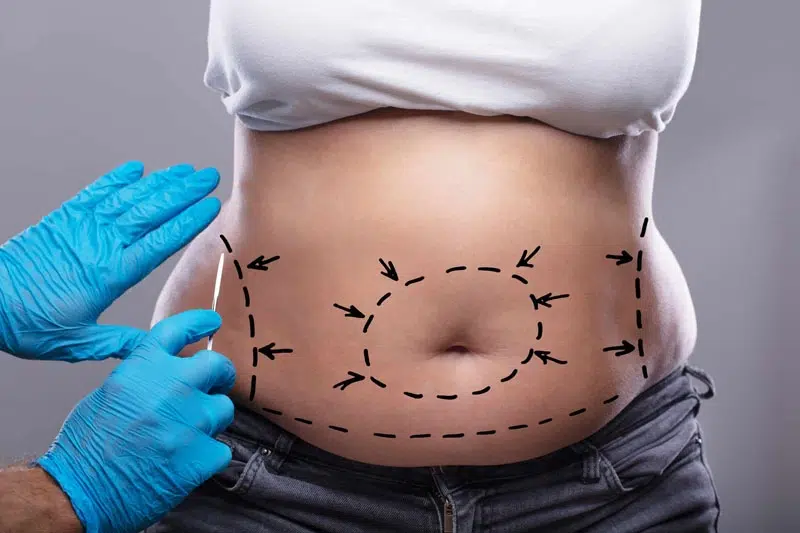 Quel est le prix d’une abdominoplastie en Tunisie ?