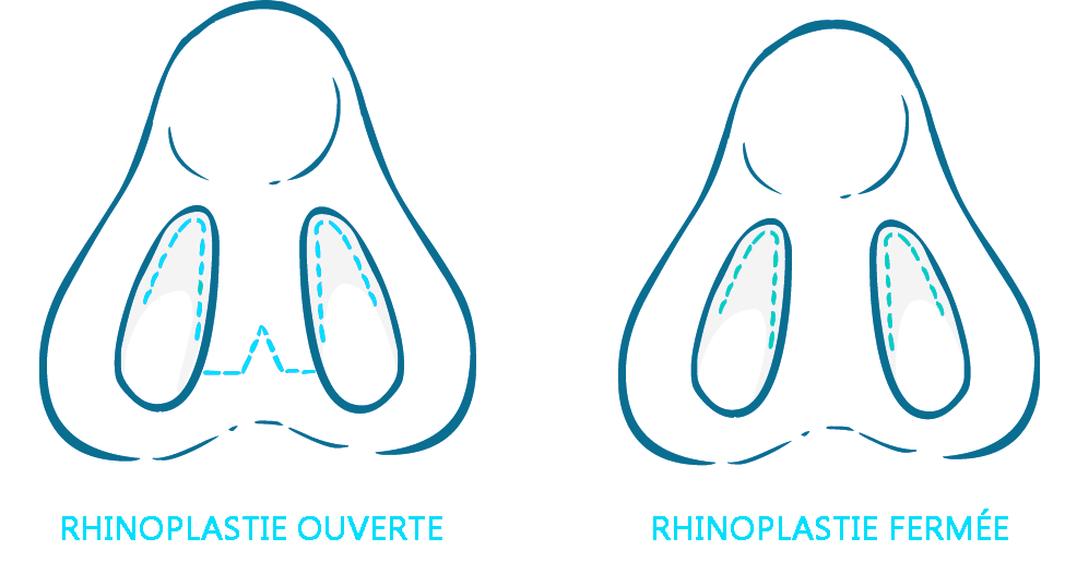 Rhinoplastie Turquie tout compris