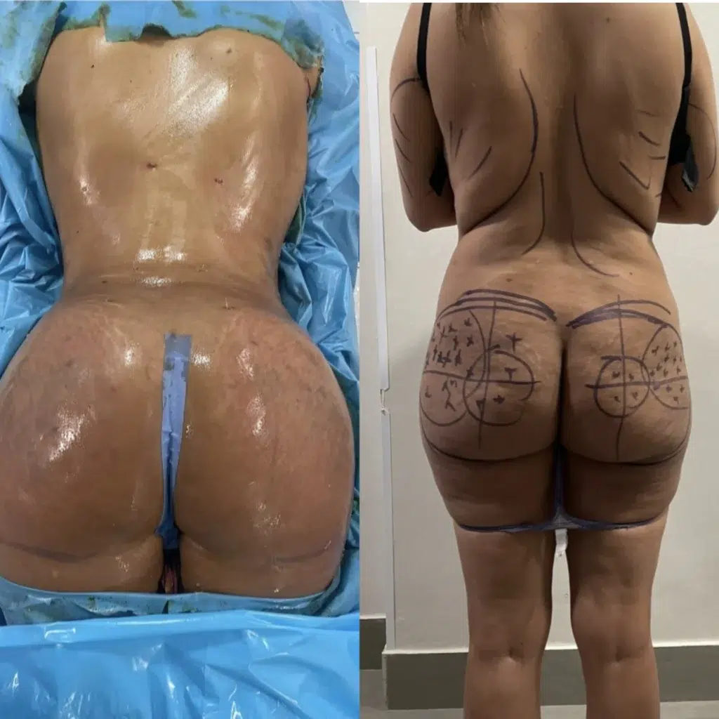 Comment garder la graisse d'un lipofilling ?, bbl chirurgie, bbl tunisie