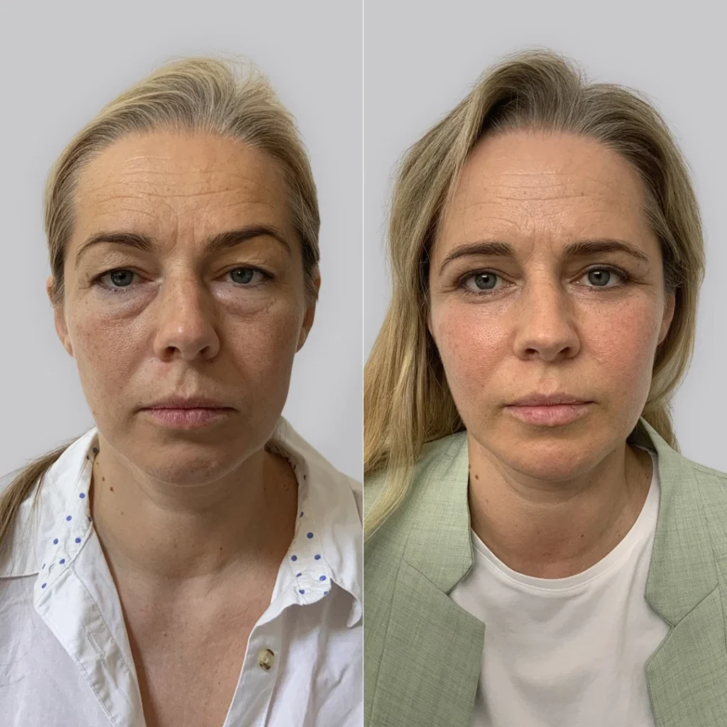 avant après blépharoplastie