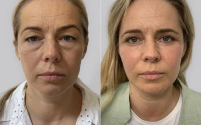 avant apres blepharoplastie La blépharoplastie offre des avantages médicaux
