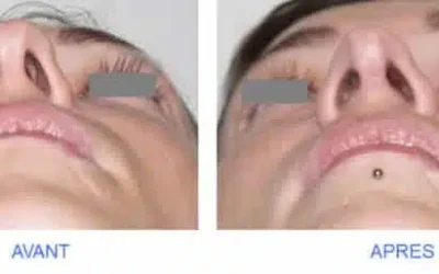greffe de cartilage rhinoplastie Rhinoplastie Marseille