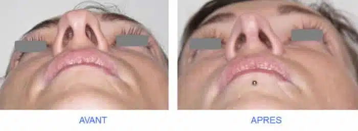 Rhinoplastie Marseille
