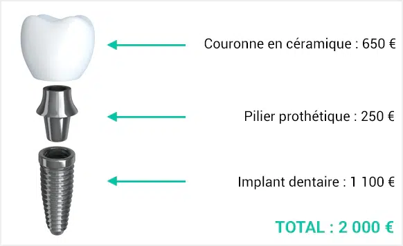 Quel est le prix d’un implant dentaire ?