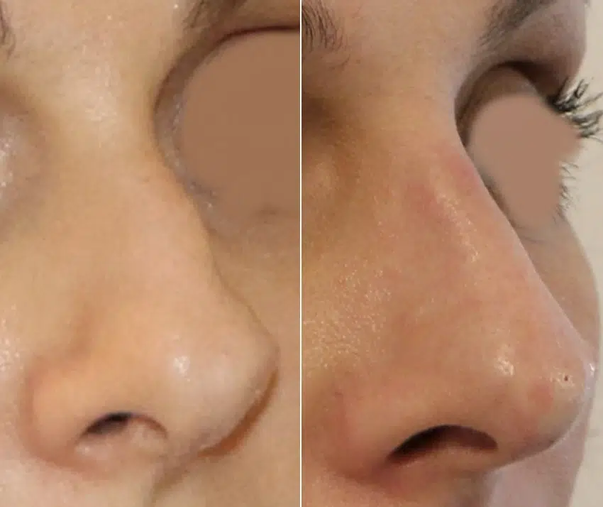 rhinoplastie médicale