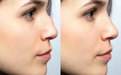 rhinoplastie turquie Estetika rhinoplastie de révision type de peau