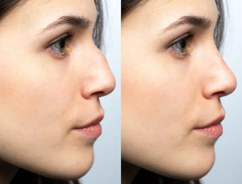 Rhinoplastie turquie chirurgie nez istanbul prix 