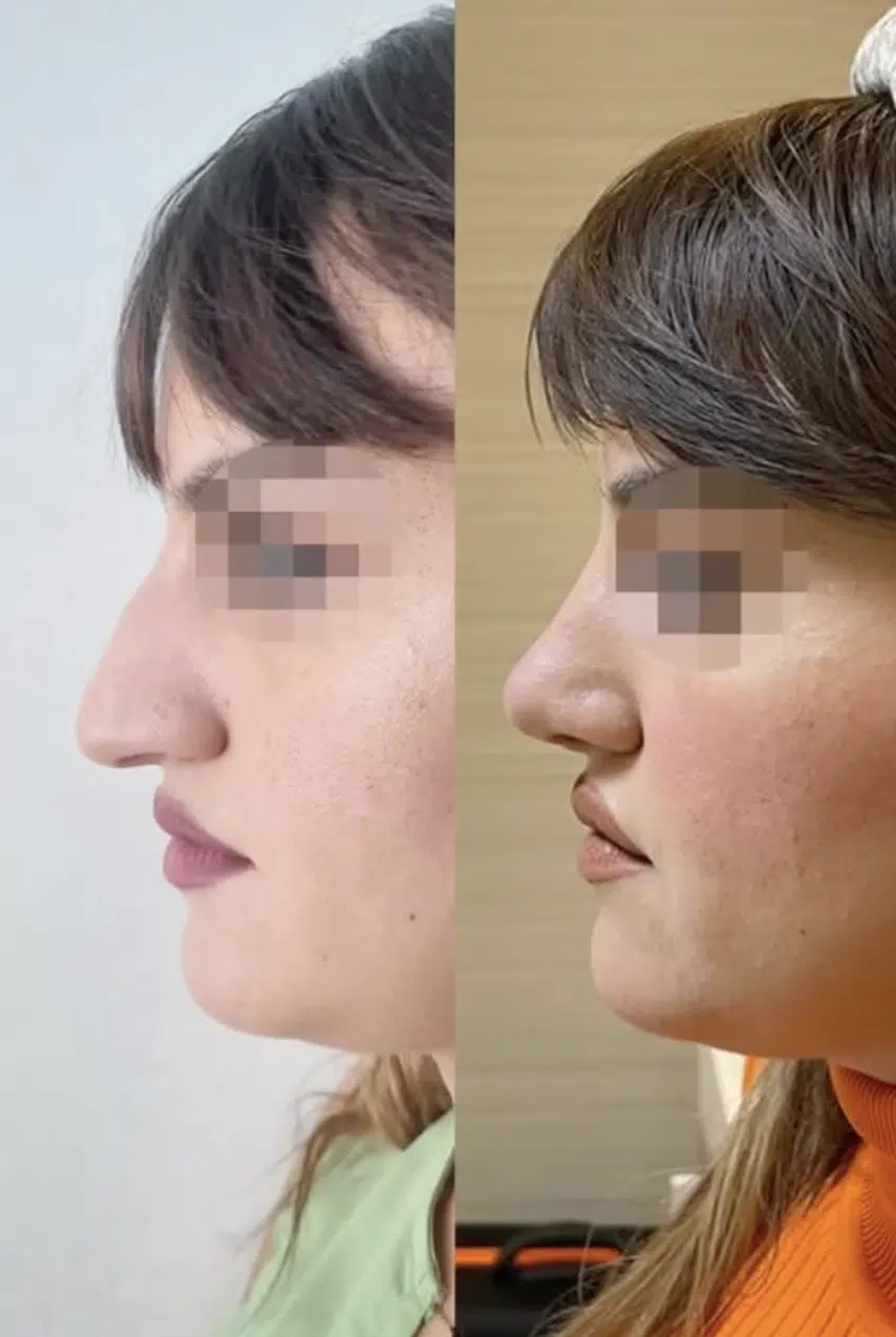 Photo rhinoplastie avant après