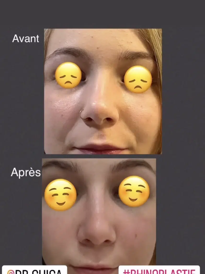 Photos avant après rhinoplastie dr guiga