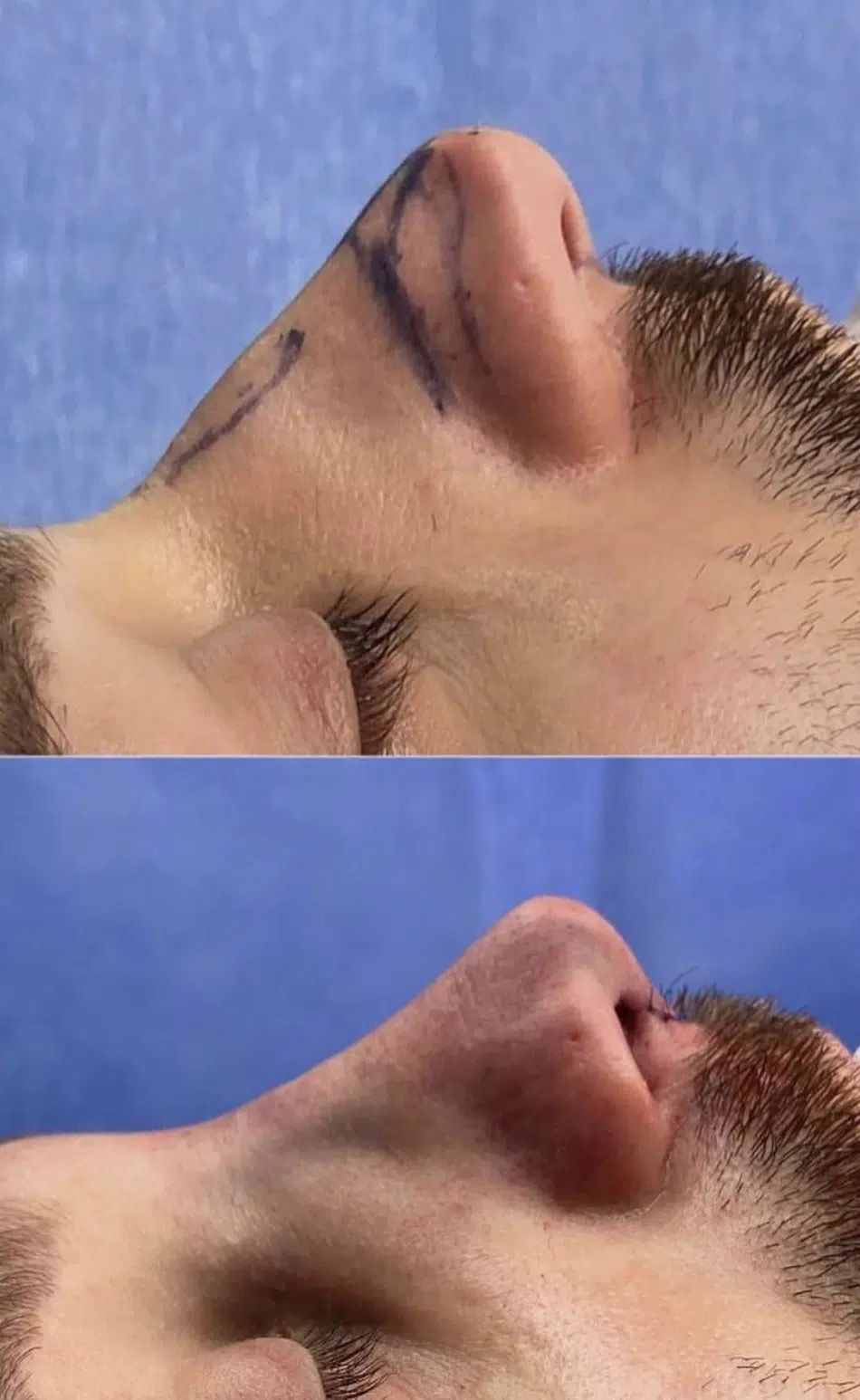 Photos avant après rhinoplastie homme bosse et pointe du nez