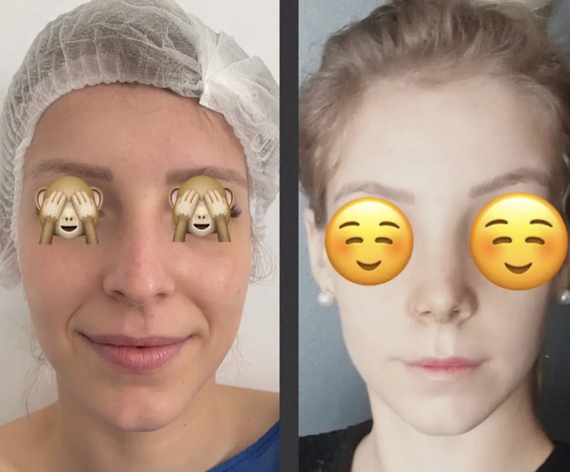 Photos avant après rhinoplastie jeune patiente