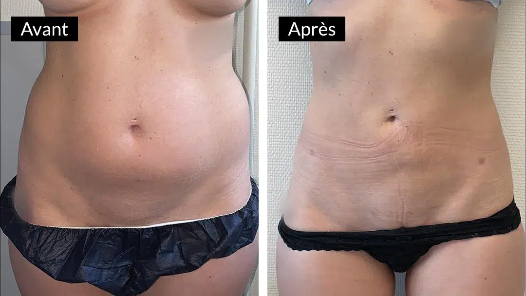 Quel âge pour une liposuccion ?