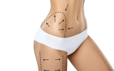 Quel est le prix dune liposuccion en Tunisie prix d’une liposuccion en Tunisie ? chirurgie esthétique