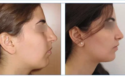 Quel prix pour refaire son nez Quel prix pour refaire son nez ?