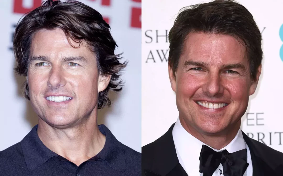 Tom Cruise chirurgie esthétique