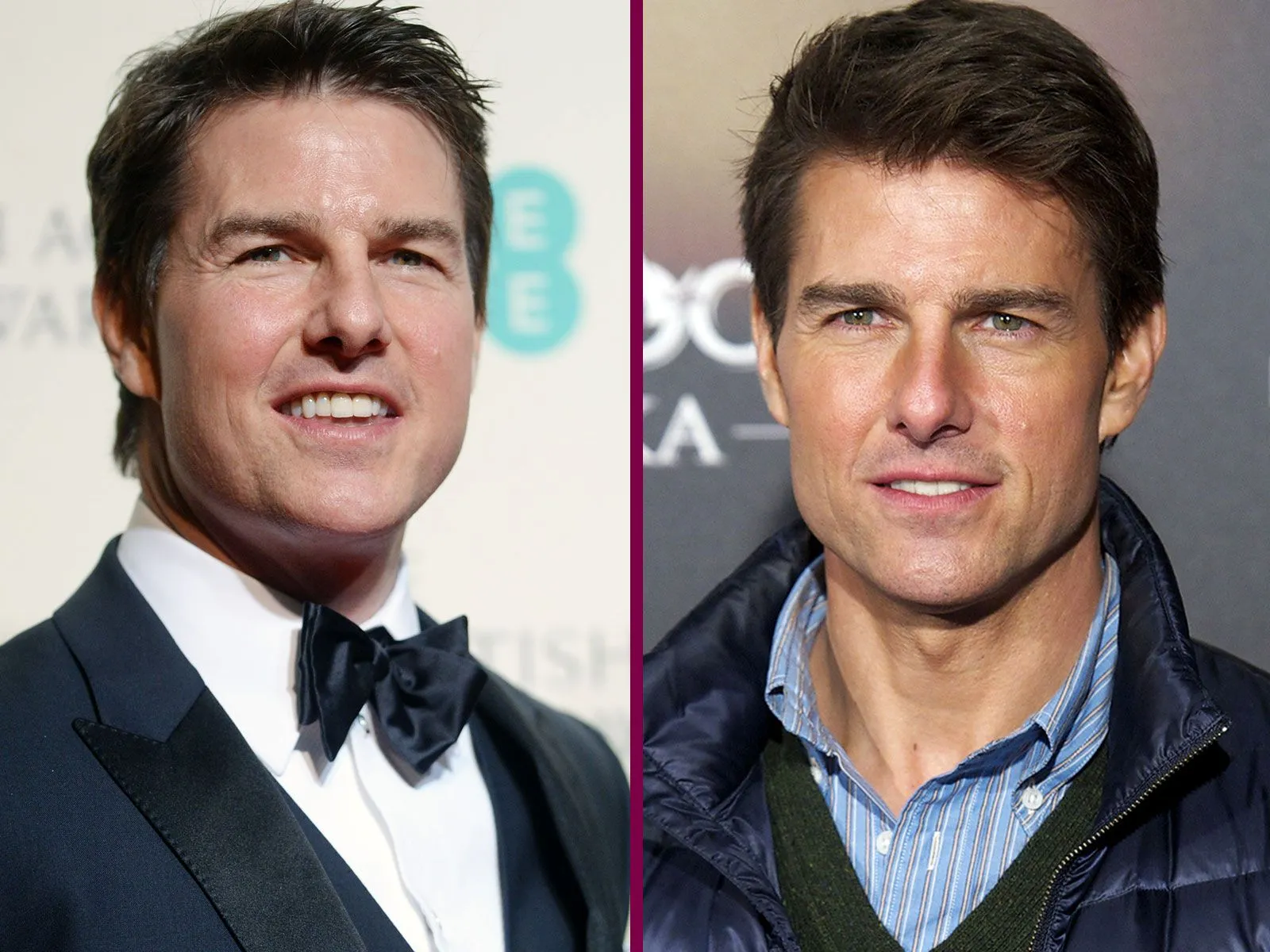 Tom cruise chirurgie esthétique  avant après