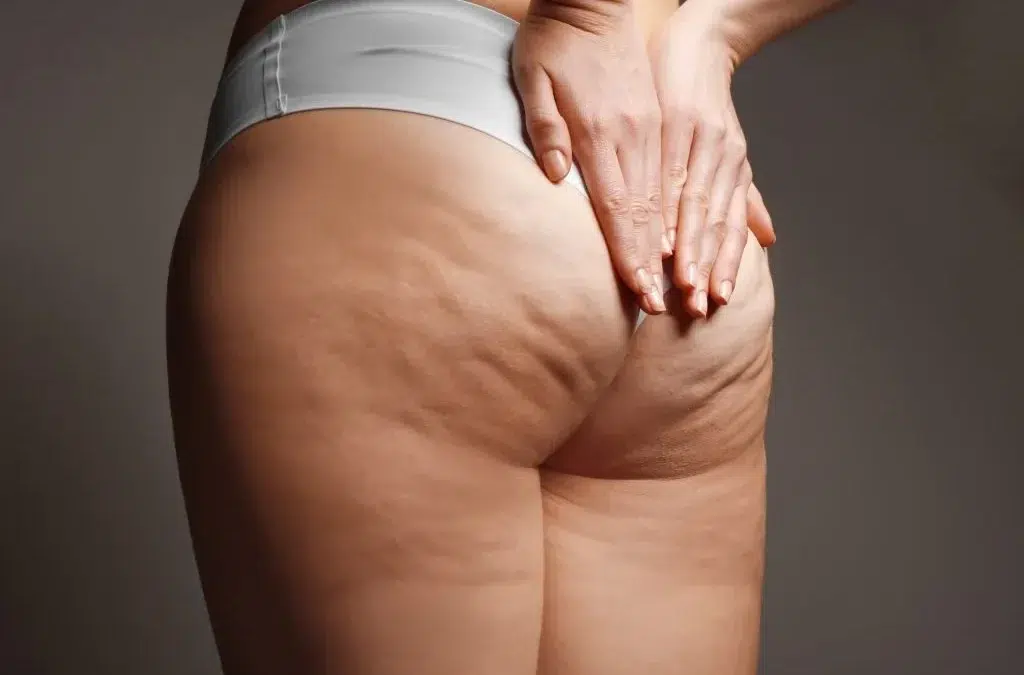 Est-ce que la liposuccion enlève la cellulite ?