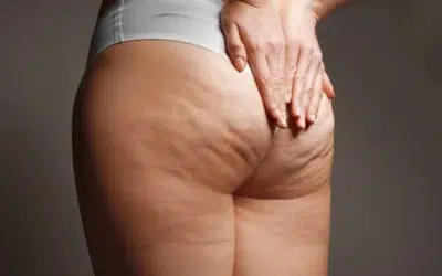 cellulite Est-ce que la liposuccion enlève la cellulite ?