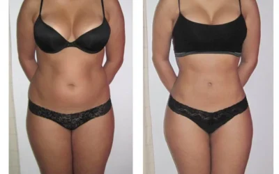 Combien coute une liposuccion