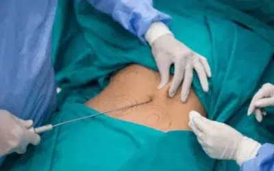 liposuccion douce tunisie estetika Quel est le coût d’une liposuccion du ventre ?