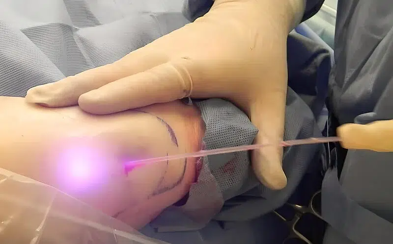 Liposuccion laser avant après lypolyse