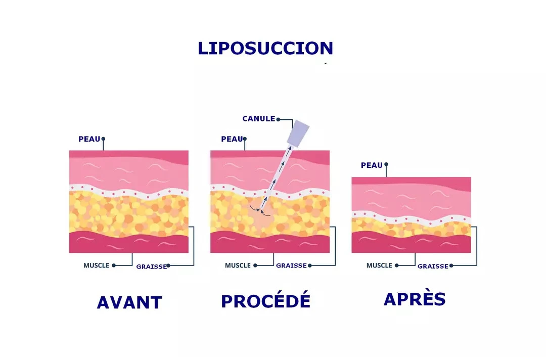 liposuccion tunisie prix