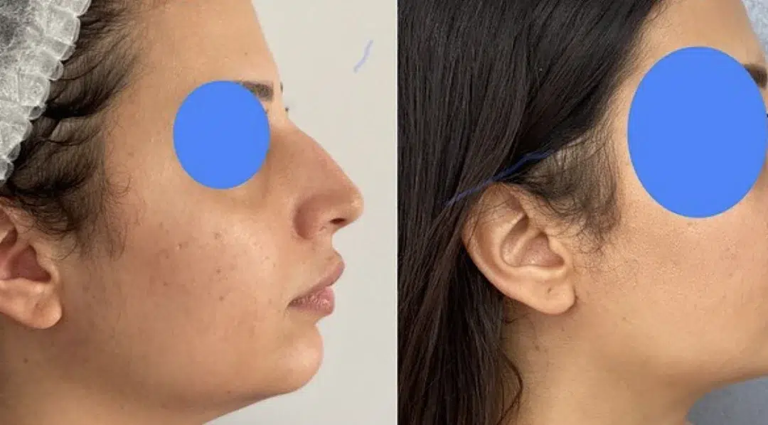 photo avant après rhinoplastie nez de profil résultat naturel, Où refaire son nez