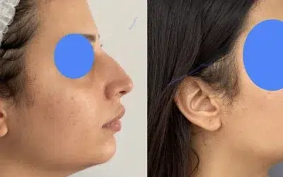 photo nez de profil resultat naturel Prix d’une rhinoplastie en france