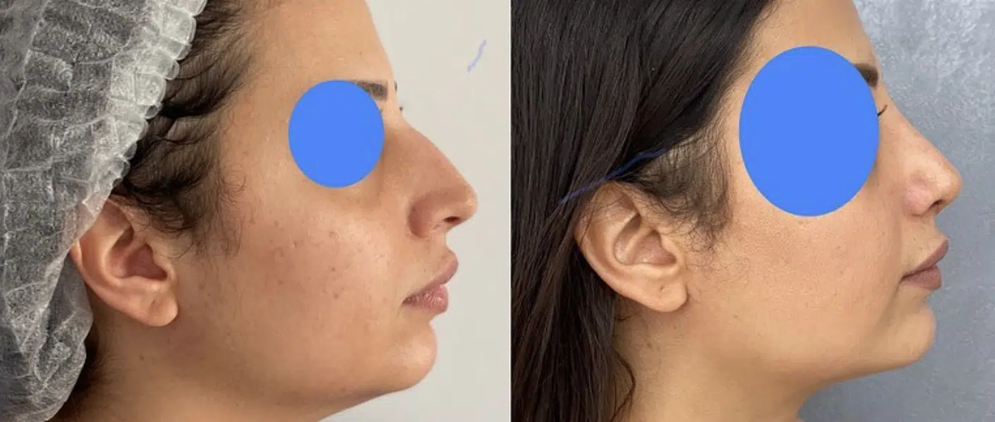 photo avant après rhinoplastie nez de profil résultat naturel