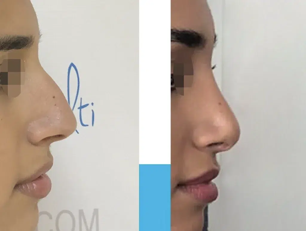 photo rhinoplastie avant apres dr Balti resultat naturel avant après rhinoplastie, rhinoplastie prix, rhinoplastie après 1 mois, oedeme rhinoplastie 3 mois après en image