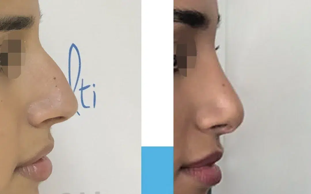 Photo avant après rhinoplastie