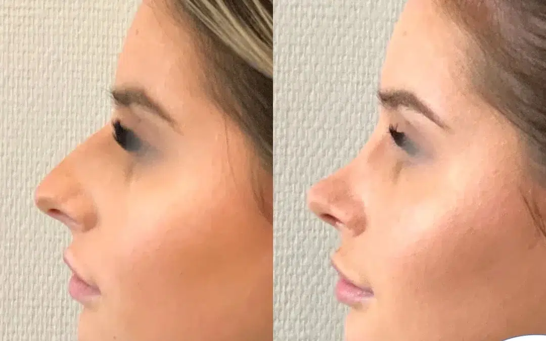 rhinoplastie en france prix​