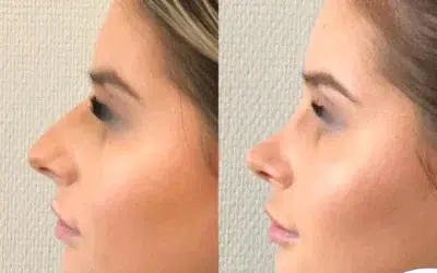 quel est le meilleur pays pour une rhinoplastie rhinoplastie en france prix