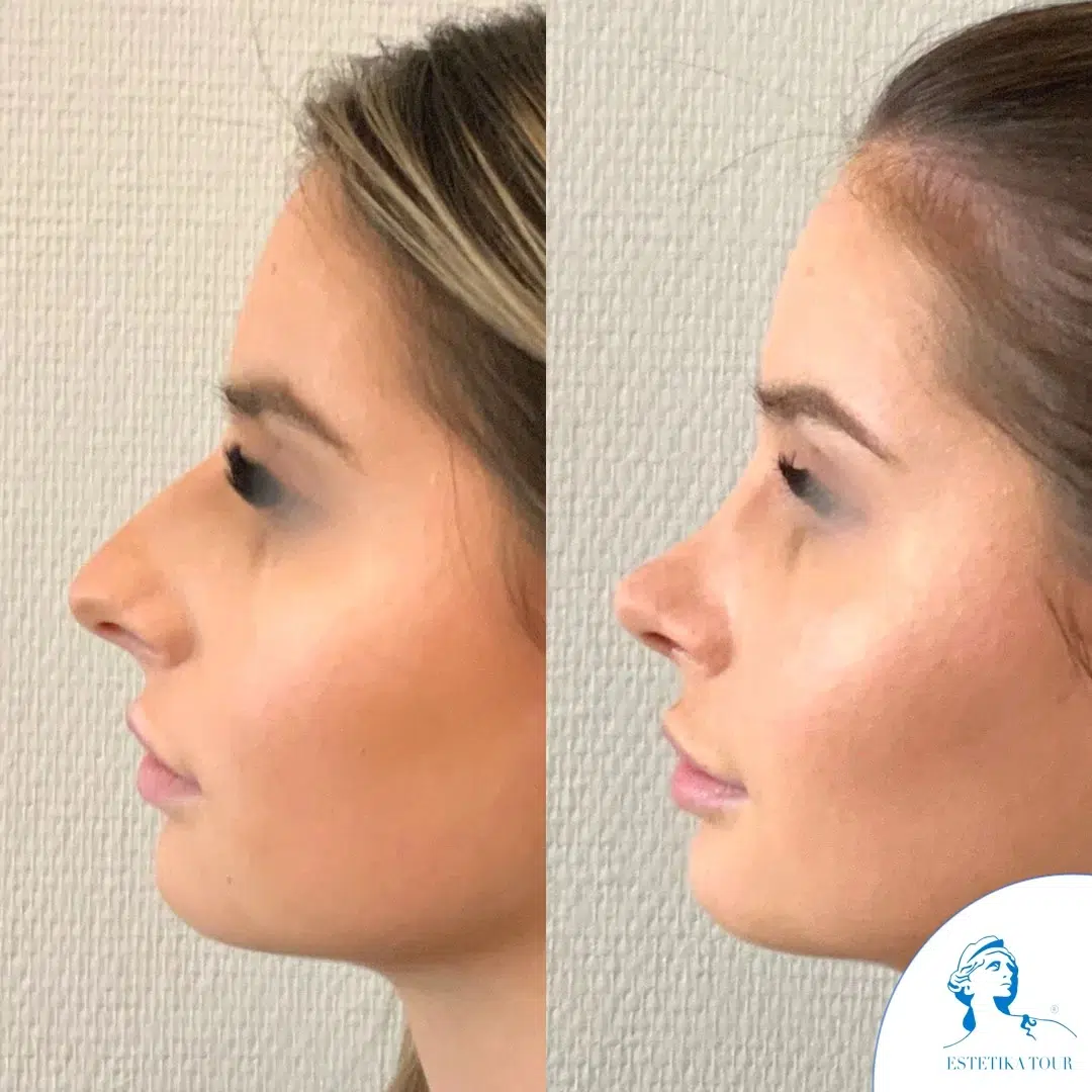 Quel est le meilleur pays pour une rhinoplastie ?