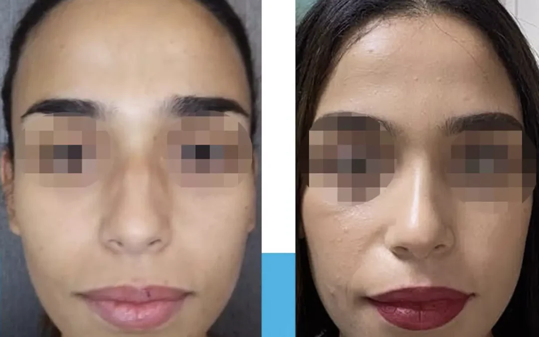 Quel est le prix d’une chirurgie esthétique du nez ?