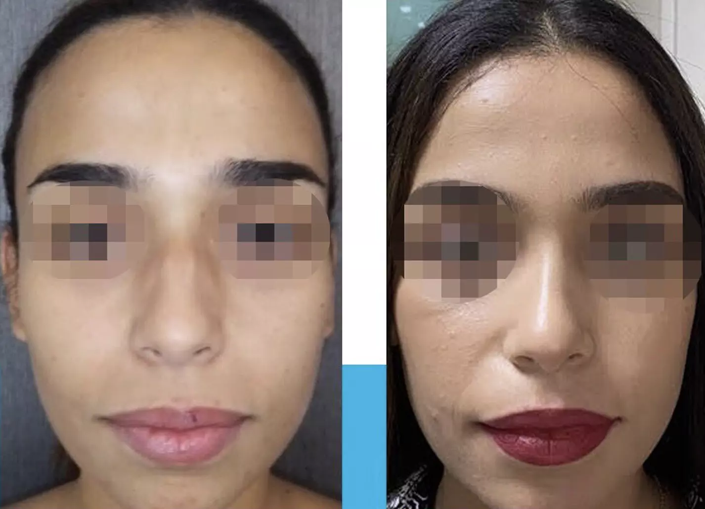 rhinoplastie ethnique avant après