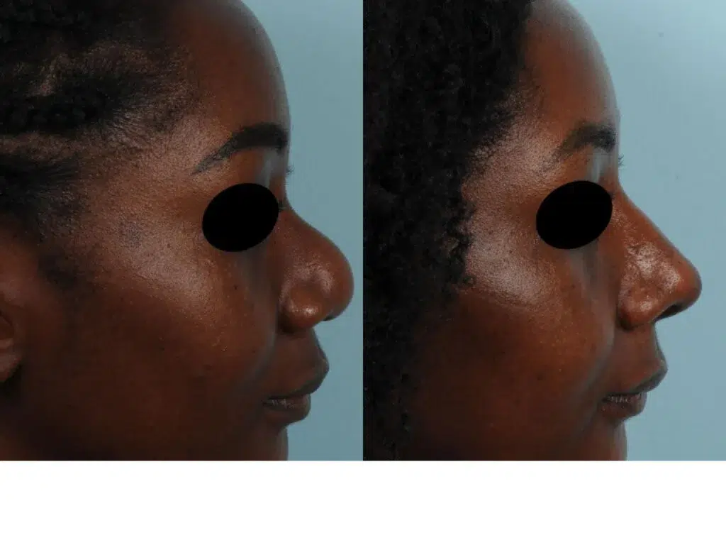 rhinoplastie ethnique