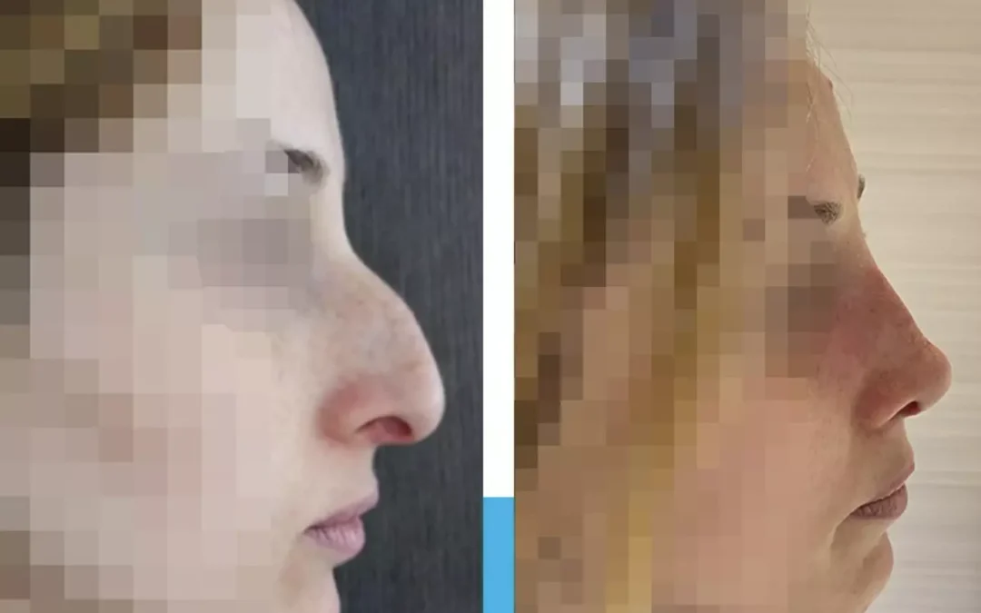 rhinoplastie avant après nez crochu, rhinoplastie lyon