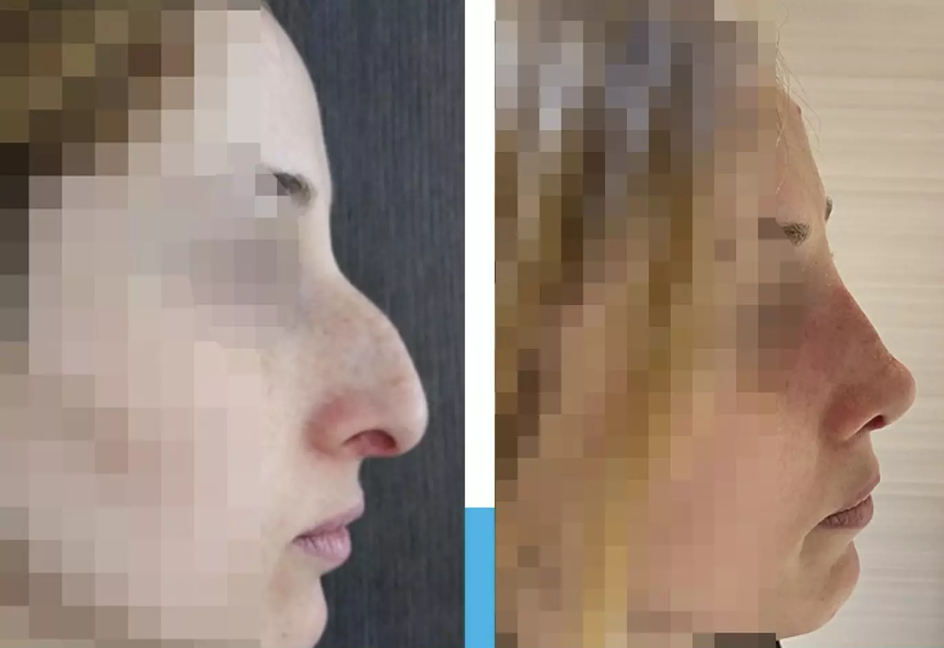 rhinoplastie avant après nez crochu