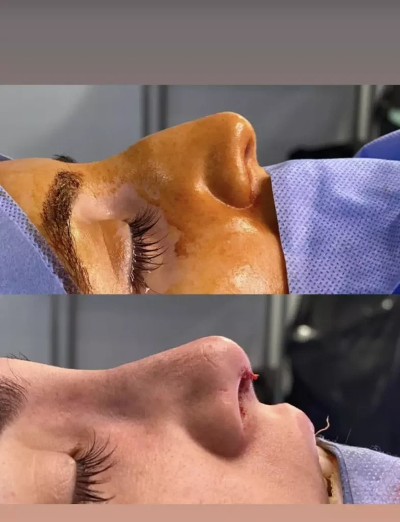 rhinoplastie photo avant apres rhinoplastie photo avant après