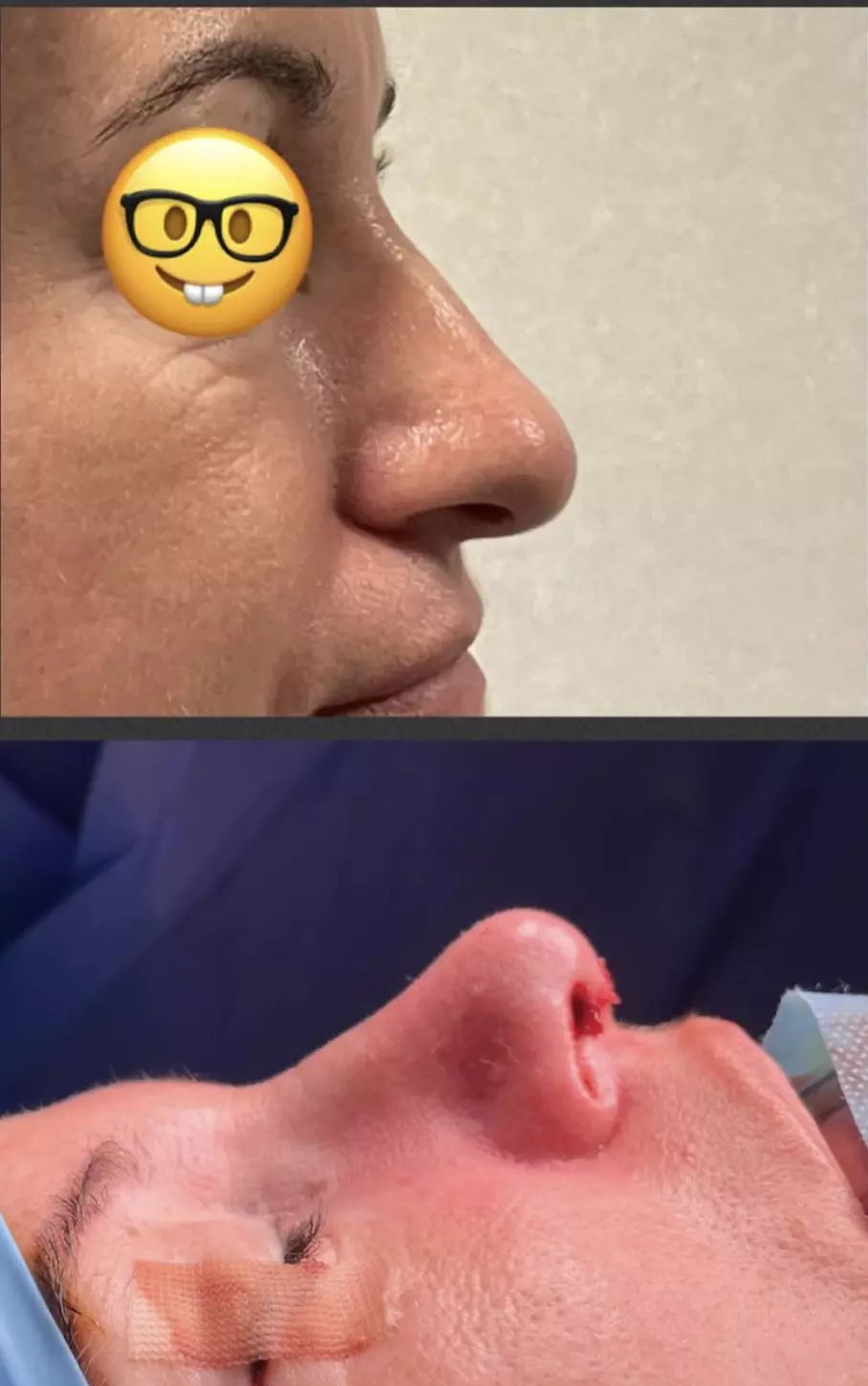 rhinoplastie pointe du nez chez une patiente