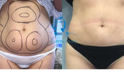 Liposuccion 1 mois apres Liposuccion 1 mois apres