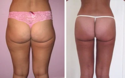Liposuccion cuisses et fesses Liposuccion des cuisses prix