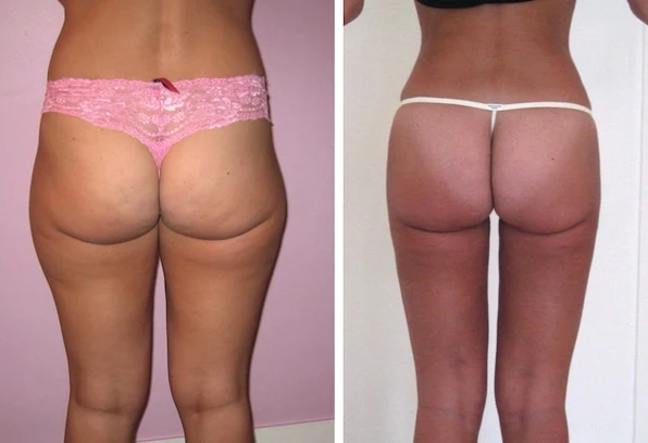 Liposuccion des cuisses prix