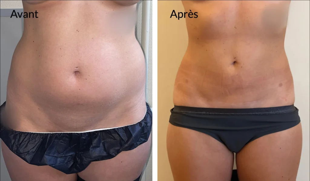 Combien coute liposuccion du ventre​