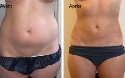 Liposuccion ventre prix lyon Combien coute liposuccion du ventre