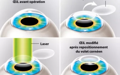 chirurgie refractive chirurgie refractive